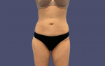 Liposuction 6 - Abdomen and Posterior Flanks After